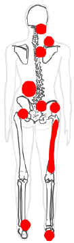 chronic pain mapping showing trigger points